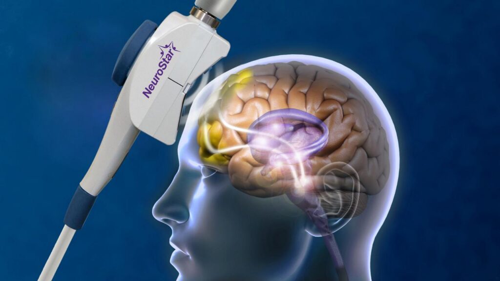 NeuroStar TMS for Depression: How This FDA-Cleared Treatment May Help